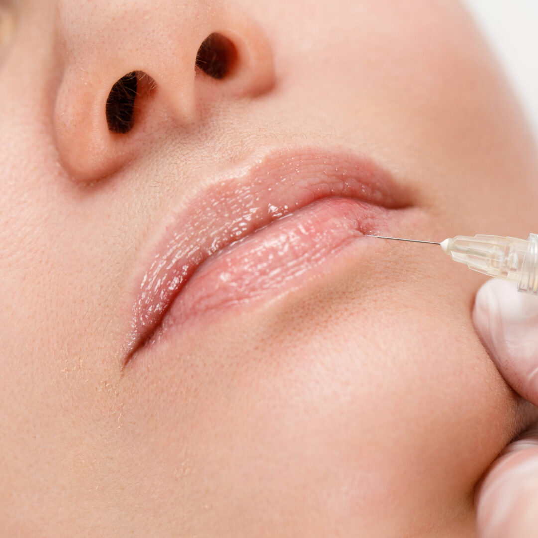 Lip shape correction procedure in a cosmetology salon. The specialist makes an injection on the lips of the patient. Lip augmentation